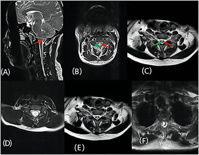 Exploring the prognostic differences in patients of Chiari malformation type I with syringomyelia undergoing different surgical methods